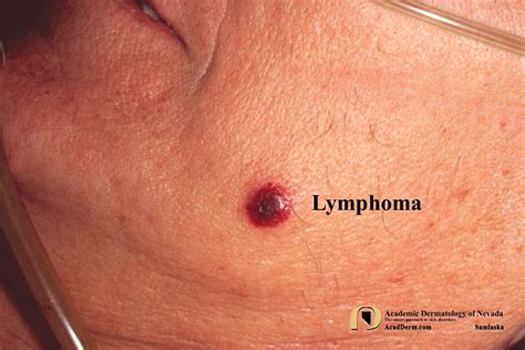 lymphoma images photos pictures